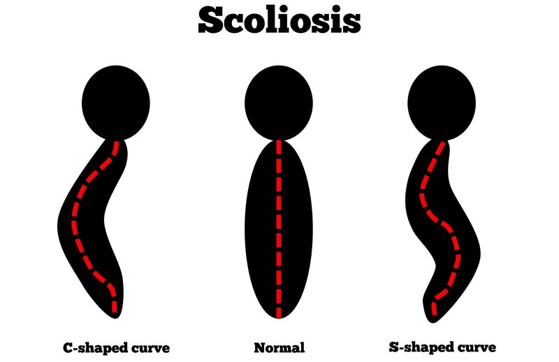 Bloomington, IL scoliosis treatment